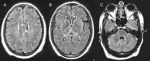 Hyperintense signal lesions (FLAIR sequencing) in the basal ganglia (B), posterior fossa (C) and with involvement of the corpus callosum (A), regarded as pathognomonic.