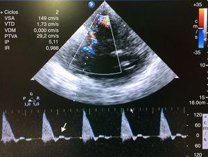 Transcranial color-coded duplex ultrasound recording. Systolic flow in left middle cerebral artery. Note the absence of diastolic flow (white arrow).