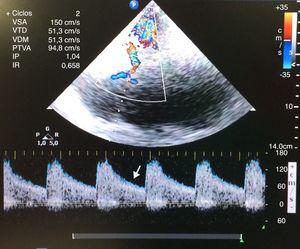 Transcranial color-coded duplex ultrasound recording. After evacuation of the pneumothorax, the diastolic wave was recovered in the left middle cerebral artery (white arrow).