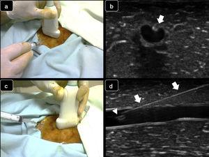 Real-time techniques for ultrasound-guided vascular cannulation. Upper panel: short axis, out-of-plane technique. (a) The needle is inserted at the middle of the transducer and then is advanced; (b) Corresponding ultrasound images. The needle is observed as an echogenic spot (arrow) along with flattening of the anterior vessel wall. Lower panel: long axis, in- plane technique: (c) The needle is inserted and advanced from one corner of the transducer; (d) Corresponding ultrasound images. The needle is entirely observed (arrows), including the bevel (arrowhead) inside the vessel.