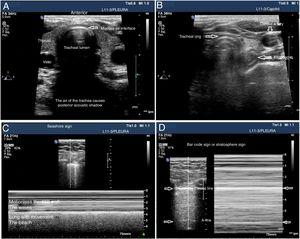 Utility of the tracheal and pleural ultrasound for OTI verification purposes. A) Tracheal ultrasound image showing the trachea with its posterior acoustic shadow surrounded by the thyroid. B) Tracheal ultrasound image with the transducer displaced towards the neck left region. The arrow points at the esophagous. C) Pleural ultrasound image with normal airing pattern indicative that the lung is insuflated. D) Pleural ultrasound image with bar code sign indicative that the lung is not insuflated. Possible contralateral selective intubation.
