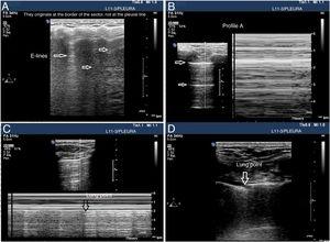 Signs of barotrauma on the pleural ultrasound. A) E-lines, vertical artifact not originated at the pleural line in relation with subcutaneous emphysema. B) A-line pattern and lack of pleural sliding as confirmed with the M-mode, on the left side, representative of the strathosphere sign. C) Image confirming the presence of pneumothorax and the separation point of the visceral from the parietal pleura (lung point) on M-mode. D) 2D image of the lung point and point of separation of both pleuras.