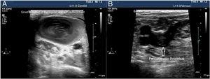 Ultrasound image of prothrombotic state. A) Cross-sectional image of the internal jugular vein with increased echogenicity inside due to prothrombotic state. B) Cross-sectional image of the common femoral vein with a non-occlusive thrombus inside.