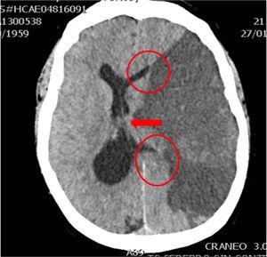 Brain CT scan showing infarction in the territory of the left middle cerebral artery. Subfalcine herniation with midline displacement and compression of the ipsilateral ventricle (courtesy of Ángela Meilán, Department of Radiology, Hospital Universitario Central de Asturias).