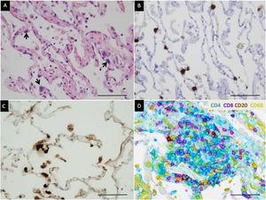 Detection of SARS-CoV-2 and characterization of inflammation. (A) Edema of alveolar walls and atypical pneumocytes with enlarged nuclei (arrow). Hematoxylin–eosin staining. (B) SARS-Cov-2 mRNA detection in atypical pneumocytes by in situ hybridization. (C) Viral nucleocapsid protein detection in atypical pneumocytes by immunohistochemistry. (D) Multiplex chromogenic detection by DAB staining (brown) of CD20+ lymphocytes, purple staining of CD8+ lymphocytes, teal staining (blue) of CD4+ lymphocytes and yellow staining of macrophages. CD4+ lymphocytes outnumber CD8+ lymphocytes in this case. The scale bar corresponds to 50μm.