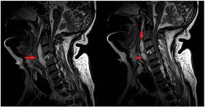 Abscessified collection in the C1–C5 paravertebral space, hyperintense on the T2-weighted sequence, that continues with a different C5-D1 collection (arrows).