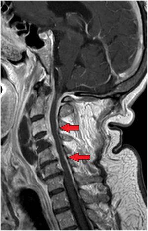Epidural damage surrounding the medullary cord from C2 to C6 on the T1-weighed sequence (arrows).
