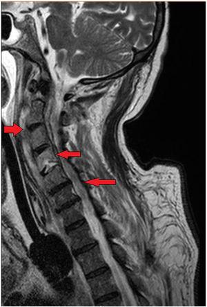 Reduction of paravertebral collection and epidural inflammatory component without evidence of the collection (arrows). Also, the arrows are pointing to the persistence of damage to the C4 vertebral body.