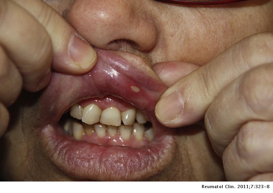 Actualmente – Que Es Aphthous Stomatitis Último Actualmente – Que Es Aphthous Stomatitis Último
