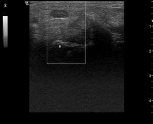 Transversal image of the median nerve in the carpal tunnel: median artery remnant. (Image obtained with a General Electrics LOGIC e ultrasound, with a lineal 8–12mHz transducer, using power Doppler with a frequency of 5.0MHz, gain of 12, PRF DE 1.2hHz and a wall filter of 180Hz.)