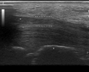 Longitudinal image of the right median nerve. (Image obtained with a General Electrics LOGIC e ultrasound, with a lineal 8–12mHz transducer, using a frequency of 12mHz.) B: large bone; N: median nerve; T: hand flexor tendons; *: compression zone.