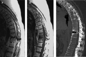 (A and B) Sagittal images of the thoracolumbar spine in T2 and T1 potentiated sequences, respectively. (C) Sagittal CT scan of the thoracolumbar spine. An alteration in the signal intensity at the D11–D12 level can be seen, corresponding with compressive myelopathy. The CT shows signs of ankylosing spondylitis (fusion of the interapophyseal facets and ossification of the common posterior vertebral ligament) along with signs of degeneration. At the level of D11–D12 the compressive myelopathy's secondary nature can be seen, as the vertebral fracture is evident.