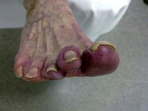 Cold induced acrocyanosis in toes of the right foot.