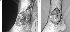 (A) Pyoderma gangrenosum of the right ankle. (B) Improvement of the lesion after treatment with infliximab.