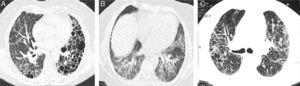 Representative CT images of RA-ILD patients. (A) Cystic lesions of subpleural and baseline distribution resembling those seen in usual interstitial pneumonia, associated with areas of ground glass. (B) Ground glass with central distribution, respecting subpleural areas and discrete reticulation, resembling the pattern observed in the nonspecific interstitial pneumonia. (C) Reticulation and ground glass diffusely distributed, broncocentric, being an indeterminate pattern of interstitial lung disease.
