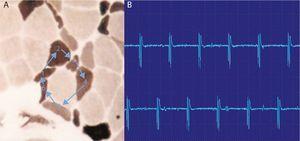High-frequency repetitive discharges. (A) The potential arises spontaneously in muscle fiber number 1 and epfatic transmission, by contiguity, passes to 2, and then to 3–6 and again at 1. (B) The electromyogram polyphasic potential starts and ends abruptly, which is always the same, and fires rhythmically, and is typically a sound like a machine, “Chaca-Chaca-Chaca”.