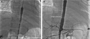 (A) and (B) Angioplasty. Placement of 2 long stents, covering the area of severe stenosis. Postoperative gradient: none. Gradient of the renal stenosis: 10mmHg. There was no procedure on the left subclavian or the renal arteries.