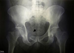 Pelvic X-ray showing osteolysis (arrow) of the superior pubic ramus, with irregular bony margins and loss of cortical bone with no periosteal reaction.