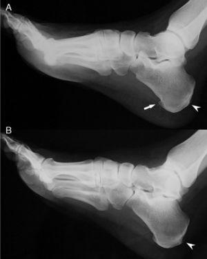 Feet X rays showing (A) a heel spur on the right foot (arrow) and bilateral Achilles entesophytes (arrowheads).
