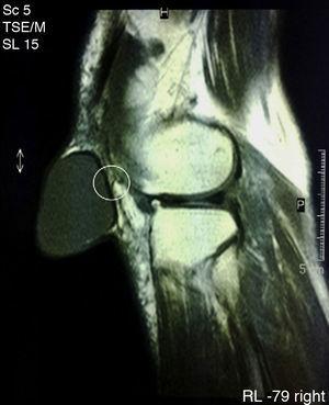 MRI of the knee. Within the circle the crease of the rear wall of the cyst is identified.