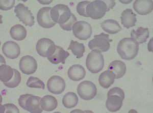 Blood smear with schistocytes and the presence of Howell-Jolly bodies. Erythrocyte basophilic stalning and irregular erythrocyte morphology.