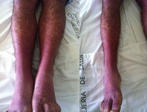 Rash and edema on the extremities.