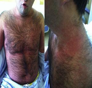 Diffuse rash of the thorax and neck.