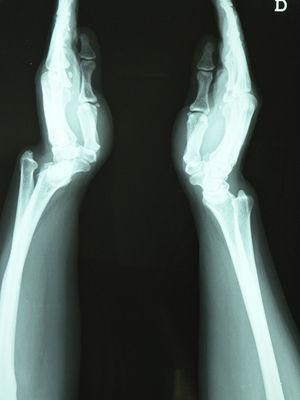 Lateral X-ray of both wrists.