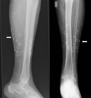 Plain X-ray of the left lower extremity, showing calcifications in the subcutaneous tissue.