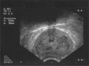 Transrectal ultrasound prostate image, with diffuse hypoechoic areas displayed.