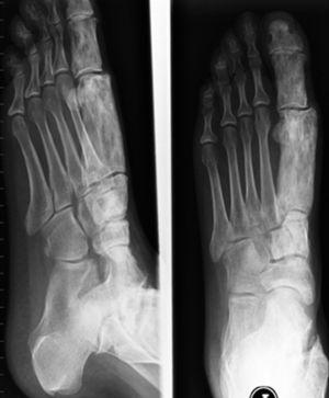 Lateral and anteroposterior X-ray of the left foot with thickening of the metatarsal and phalange of the first right toe.