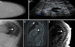 (A) Mammography BIRADS I. (B) Adenopathy with cortical thickening suspicious of metastasis. (C–E) A D7 vertebral fracture with a sclerotic pattern is seen in the sagittal CT and a hypointense signal on MR imaging T1.