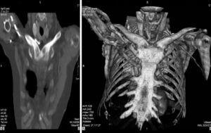 CT scan of the chest where clavicular hyperostosis and ankylosis of the sterno-clavicular joint are observed.