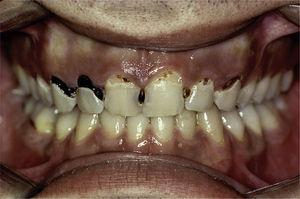 Primary Sjögren's syndrome patient with a great number of caries on atypical surfaces.