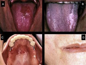Types of oral candidiasis that can develop in primary Sjögren's syndrome patients: (A) Erythematous candidiasis. (B) Pseudomembranous candidiasis. (C) Candidiasis on areas covered by removable dentures. (D) Angular cheilitis.