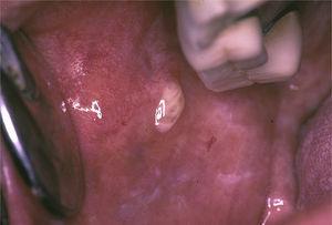 Purulent discharge from Stensen's duct orifice in a patient with primary Sjögren's syndrome.