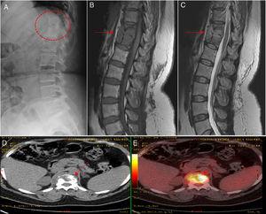 (A) The radiological study shows bone rarefaction in thoracic vertebral bodies T11 and T12, with marked erosion of their anterior borders. (B) Magnetic resonance study shows a lobulated lesion and collection affecting T11, T12 and their respective intervertebral disc (arrow), which is hypointense on a T1-weighted image. (C) Magnetic resonance study showing hyperintensity on a T2-weighted image (solid arrows). (D and E) Positron emission tomography images confirming the high metabolic activity of the lesions (broken arrows).