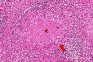 Presence of multiple granulomas formed by the accumulation of epithelioid histiocytes (arrow), surrounded by central caseous necrosis (star) (hematoxylin and eosin, 400×).