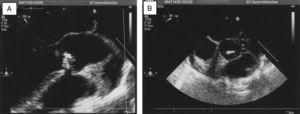 (A and B) Transthoracic echocardiography. The image shows the vegetation on the partially calcified bicuspid aortic valve, which appears with a partial prolapse and severe regurgitation. There is no evidence of heart failure.