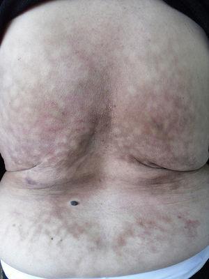 Erythematous, violaceous, reticulated rash, with patches of brownish skin of atrophic appearance, that affects the entire area exposed to the heat source, except the central lumbar portion on which her body did not rest heavily.