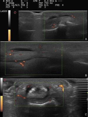 Ultrasound images of the 4th finger of the patient's right hand. (A) Long-axis view of middle-distal phalanges, with grade 1 power Doppler signal. (B) Long-axis view of proximal phalanx-metacarpus, with grade 2 power Doppler signal. (C) Cross-sectional view of proximal phalanx-metacarpus, with grade 2 power Doppler signal.