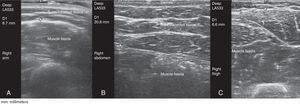 Ultrasound images of subcutaneous tissue. (A) Right arm. (B) Right abdomen. (C) Right thigh.