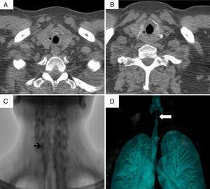 Computed tomography of larynx and trachea in patient no. 3. (A and B) Axial images showing the subglottic stenosis with concentric circumferential thickening of the mucosa (*) partially obstructing the tracheal lumen. (C) Subglottic stenosis (arrow). (D) Volumetric reconstruction of subglottic stenosis (arrow).