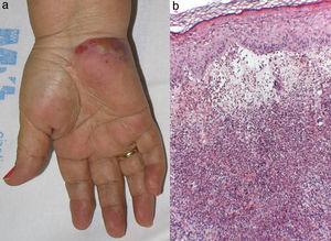 (a) A large pustule in an erythematous violaceous plaque on the palm of the patient's hand. (b) Hematoxylin and eosin (10×). Dense dermic neutrophilic infiltrate with marked edema, without leukocytoclastic vasculitis.