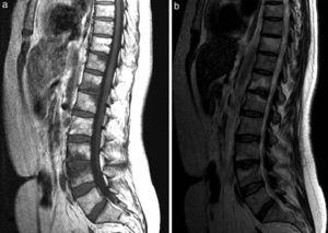 Sagittal T1-weighted image of thoracolumbar spine (a). Abnormality of the focal bone marrow signal, in relation to superior vertebral endplates at T11, and endplates at T12/L1 and L3/4. Involvement of L3/4 is associated with collapse of the superior vertebral endplate, with irregular margins. Sagittal T2-weighted image of thoracolumbar spine (b), which shows T2-weighted hyperintensity corresponding to the abnormal areas in the T1-weighted signal, compatible with a pattern of substitution of normal bone marrow due to reactive/inflammatory edema given the relationship to joint surfaces.