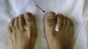 Physical examination of both feet shows onychodystrophy, dactylitis and periungual erythema (arrow) in the great toe of the right foot.