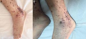 Vesiculobullous form of cutaneous leukocytoclastic vasculitis. (A) Prior to antibiotic therapy. (B) After antibiotic therapy.
