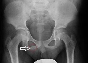 Anteroposterior radiograph of pelvis: swelling of right ischiopubic synchondrosis.