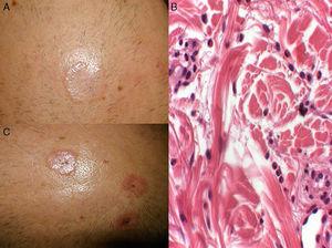 (A and C) Circular, skin-colored and erythematous plaques measuring 2–4cm, with a more infiltrated border and small scabs on the surface. (B) Histiocytes interspersed with bundles of degenerated collagen accompanied by an inflammatory infiltrate with abundant eosinophils (hematoxylin-eosin, 20×).