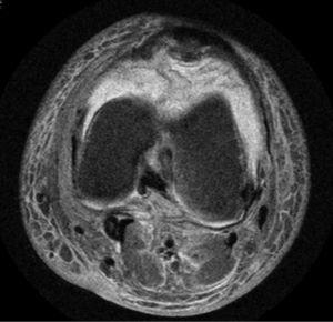 Coronal T2-weighted magnetic resonance image of the left knee of the patient. A hyperintense signal can be observed in the anterior region in different phases compatible with hemarthrosis.